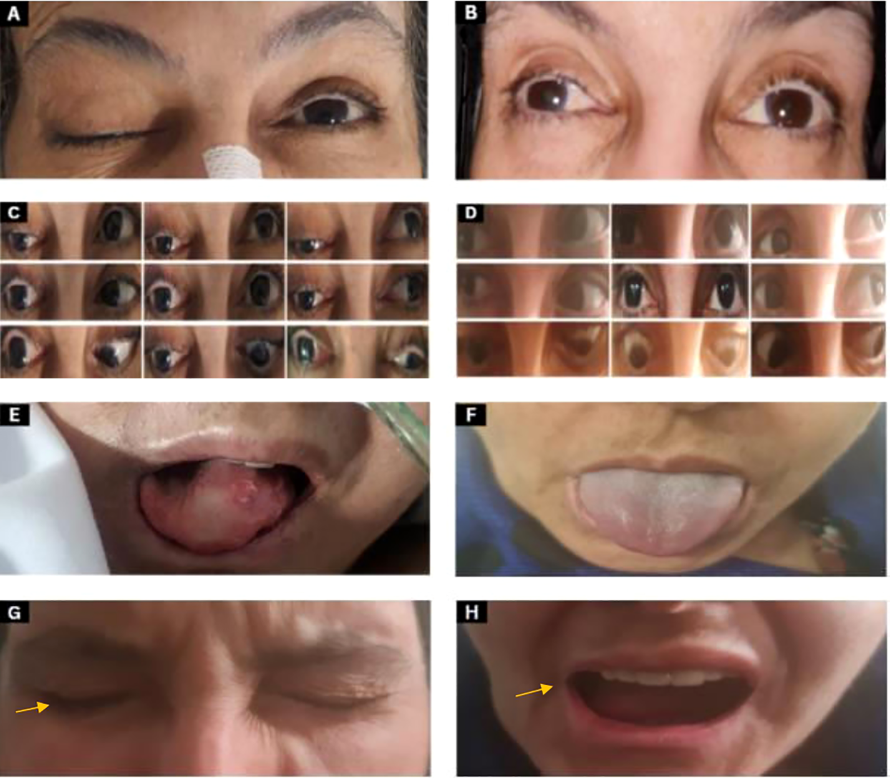 Frontiers | Extensive locally invasive nasopharyngeal carcinoma involving  10 cranial nerves palsies: an interesting case report